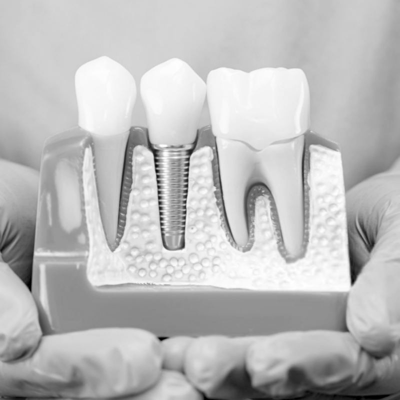 What Is the Dental Implant Process?